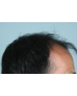 Before Hair Transplant&nbsp;2 Sessions (Areas)